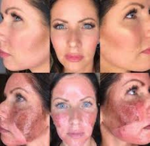 Resurfacing chemical peel - chemical, 90%